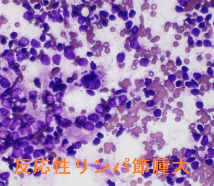 反応性リンパ節腫大 穿刺細胞診 反応性リンパ節腫大 穿刺細胞診