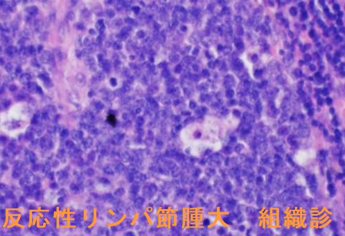 反応性リンパ節腫大 組織診 反応性リンパ節腫大 組織診