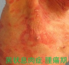 菌状息肉症 腫瘍期 菌状息肉症 腫瘍期
