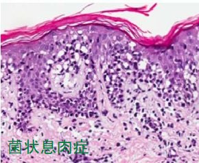菌状息肉症の皮膚生検、組織診 菌状息肉症の皮膚生検、組織診