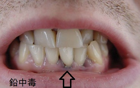 鉛中毒 鉛中毒