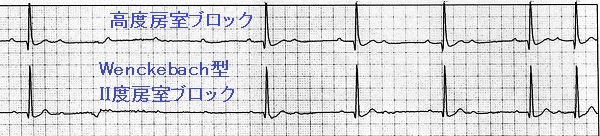 Wenckebach型II度房室ブロックと高度房室ブロック Wenckebach型II度房室ブロックと高度房室ブロック
