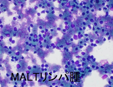 MALTリンパ腫 細胞診 MALTリンパ腫 細胞診