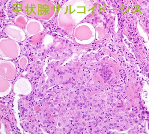 甲状腺サルコイドーシス 組織像 甲状腺サルコイドーシス 組織像