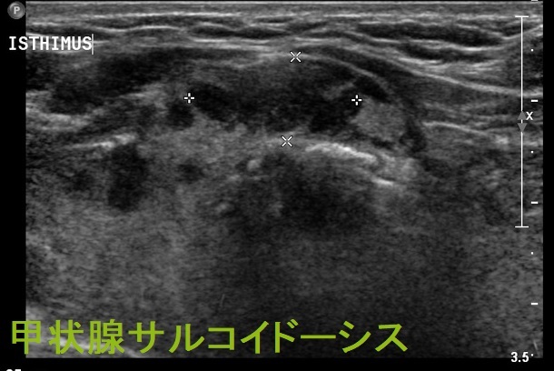 甲状腺サルコイドーシス 超音波(エコー)画像 甲状腺サルコイドーシス 超音波(エコー)画像