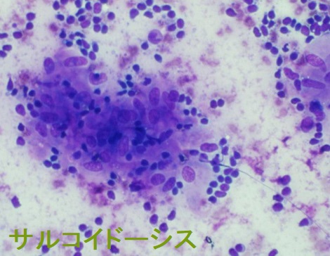 甲状腺サルコイドーシス 細胞診 甲状腺サルコイドーシス 細胞診