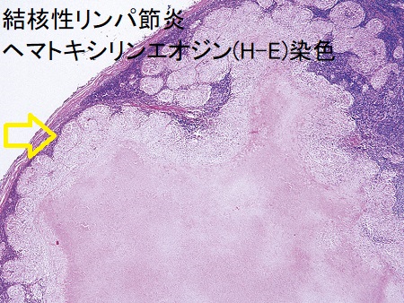 結核性リンパ節炎 リンパ節生検 ヘマトキシリンエオジン(H-E)染色 結核性リンパ節炎 リンパ節生検 ヘマトキシリンエオジン(H-E)染色