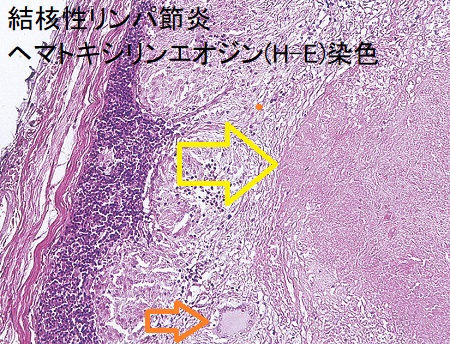 結核性リンパ節炎 リンパ節生検 ヘマトキシリンエオジン(H-E)染色 結核性リンパ節炎 リンパ節生検 ヘマトキシリンエオジン(H-E)染色