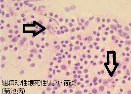 組織球性壊死性リンパ節炎(菊池病) 穿刺細胞診 組織球性壊死性リンパ節炎(菊池病) 穿刺細胞診