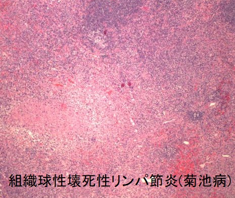 組織球性壊死性リンパ節炎(菊池病) 組織像 組織球性壊死性リンパ節炎(菊池病) 組織像