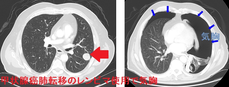 甲状腺癌肺転移のレンビマ®(レンバチニブ)投与で気胸 甲状腺癌肺転移のレンビマ®(レンバチニブ)投与で気胸