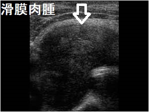 滑膜肉腫 超音波(エコー)画像 滑膜肉腫 超音波(エコー)画像