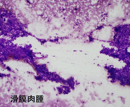 滑膜肉腫 穿刺細胞診 滑膜肉腫 穿刺細胞診