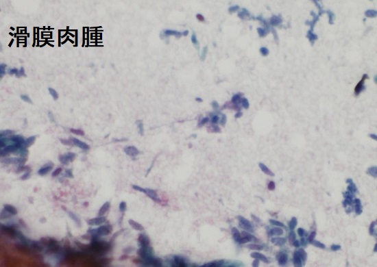 滑膜肉腫 穿刺細胞診 滑膜肉腫 穿刺細胞診
