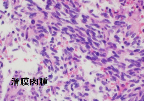 滑膜肉腫 組織像 滑膜肉腫 組織像
