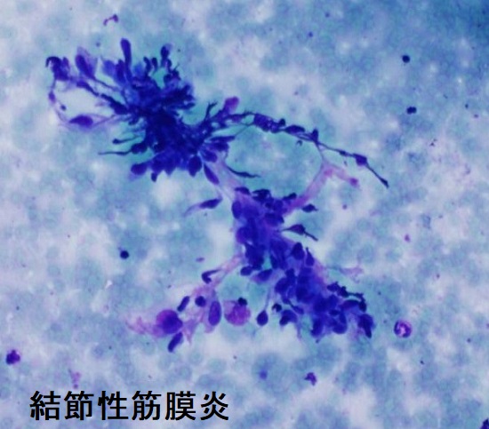 結節性筋膜炎 細胞診 結節性筋膜炎 細胞診
