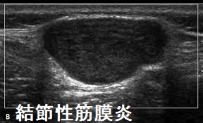 結節性筋膜炎 超音波(エコー)画像 結節性筋膜炎 超音波(エコー)画像