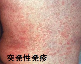 突発性発疹 突発性発疹