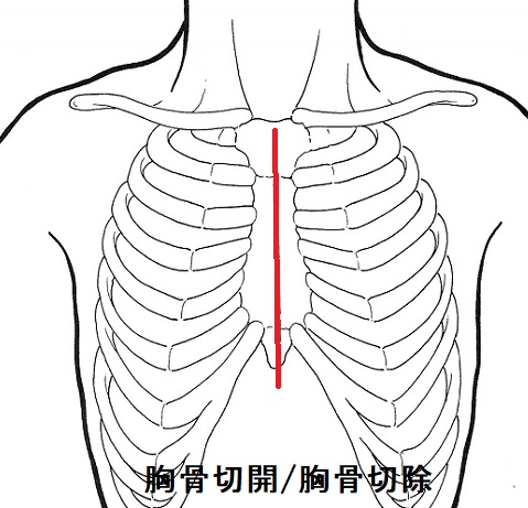 胸骨切開 胸骨切除 胸骨切開 胸骨切除