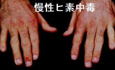 慢性ヒ素中毒 慢性ヒ素中毒