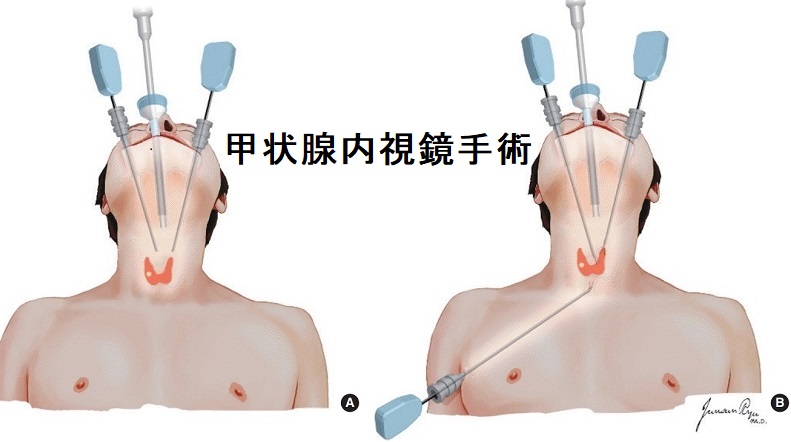 甲状腺ロボット手術・甲状腺内視鏡手術[橋本病 バセドウ病