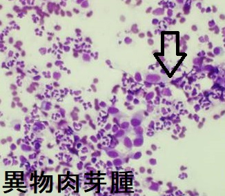 手術と放射線治療後異物肉芽腫 細胞診 手術と放射線治療後異物肉芽腫 細胞診