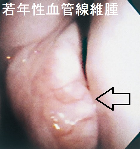 若年性血管線維腫 内視鏡 若年性血管線維腫 内視鏡