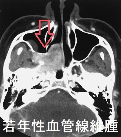 若年性血管線維腫 副鼻腔造影CT 若年性血管線維腫 副鼻腔造影CT