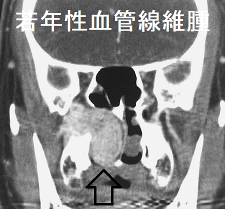 若年性血管線維腫 副鼻腔造影CT 若年性血管線維腫 副鼻腔造影CT