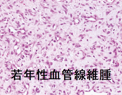 若年性血管線維腫 組織 若年性血管線維腫 組織