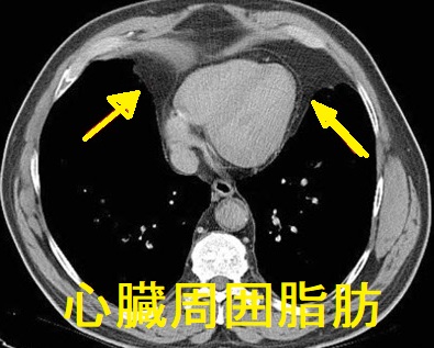心臓周囲脂肪 心臓周囲脂肪