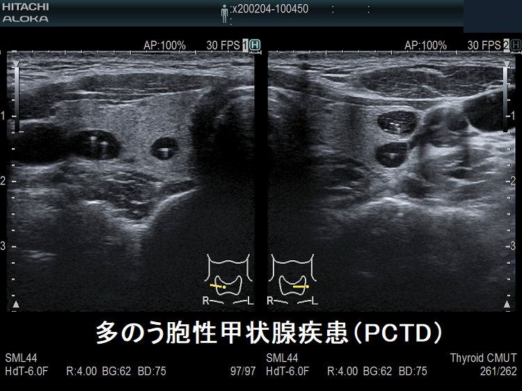 多のう胞性甲状腺疾患(PCTD) 超音波(エコー)画像 多のう胞性甲状腺疾患(PCTD) 超音波(エコー)画像