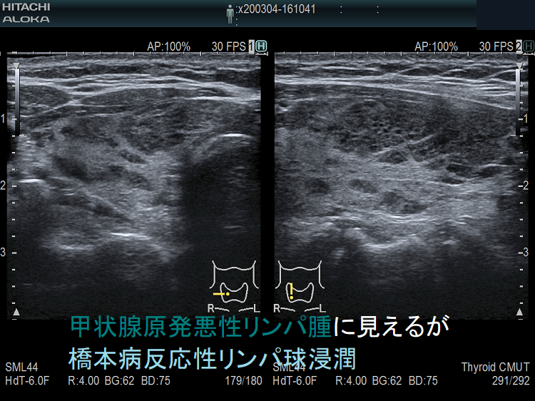 甲状腺原発悪性リンパ腫に見えるが橋本病反応性リンパ球浸潤 超音波(エコー)画像 甲状腺原発悪性リンパ腫に見えるが橋本病反応性リンパ球浸潤 超音波(エコー)画像