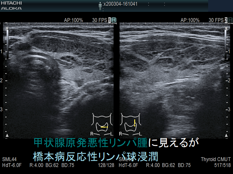 甲状腺原発悪性リンパ腫に見えるが橋本病反応性リンパ球浸潤 超音波(エコー)画像 甲状腺原発悪性リンパ腫に見えるが橋本病反応性リンパ球浸潤 超音波(エコー)画像