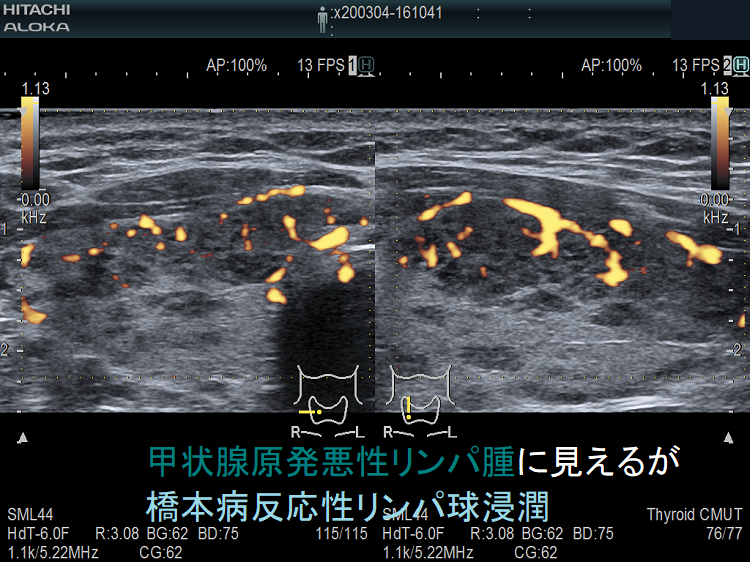 甲状腺原発悪性リンパ腫に見えるが橋本病反応性リンパ球浸潤 超音波(エコー)画像(拡大) 甲状腺原発悪性リンパ腫に見えるが橋本病反応性リンパ球浸潤 超音波(エコー)画像(拡大)