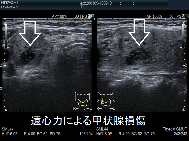 遠心力による甲状腺損傷 超音波(エコー)画像 遠心力による甲状腺損傷 超音波(エコー)画像