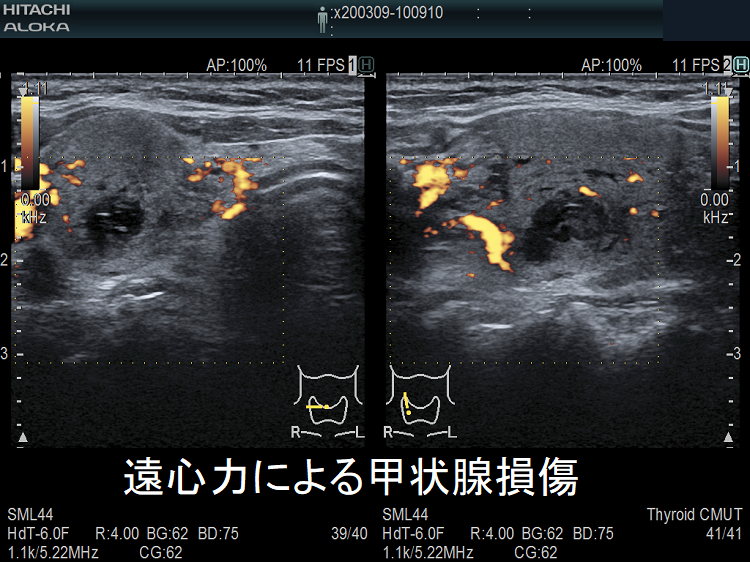 遠心力による甲状腺損傷 超音波(エコー)画像 ドプラーモード 遠心力による甲状腺損傷 超音波(エコー)画像 ドプラーモード