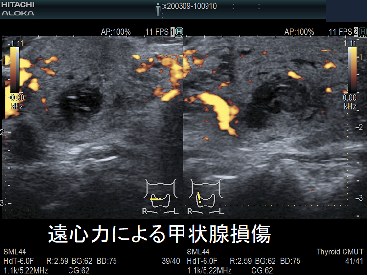 遠心力による甲状腺損傷 超音波(エコー)画像 拡大 遠心力による甲状腺損傷 超音波(エコー)画像 拡大