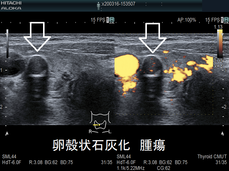 卵殻状石灰化 腫瘍 超音波(エコー)画像 卵殻状石灰化 腫瘍 超音波(エコー)画像