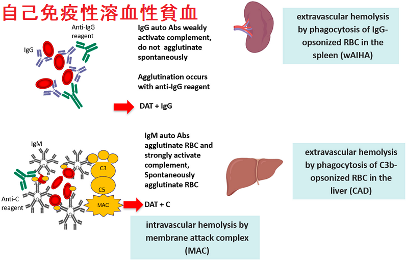 自己免疫性溶血性貧血'(AIHA) 自己免疫性溶血性貧血'(AIHA)