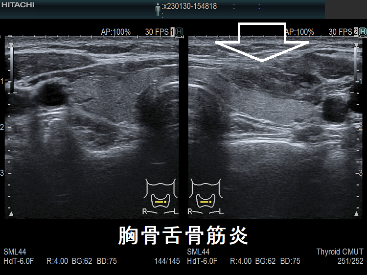 頸筋炎 胸骨舌骨筋炎 超音波(エコー)画像 頸筋炎 胸骨舌骨筋炎 超音波(エコー)画像