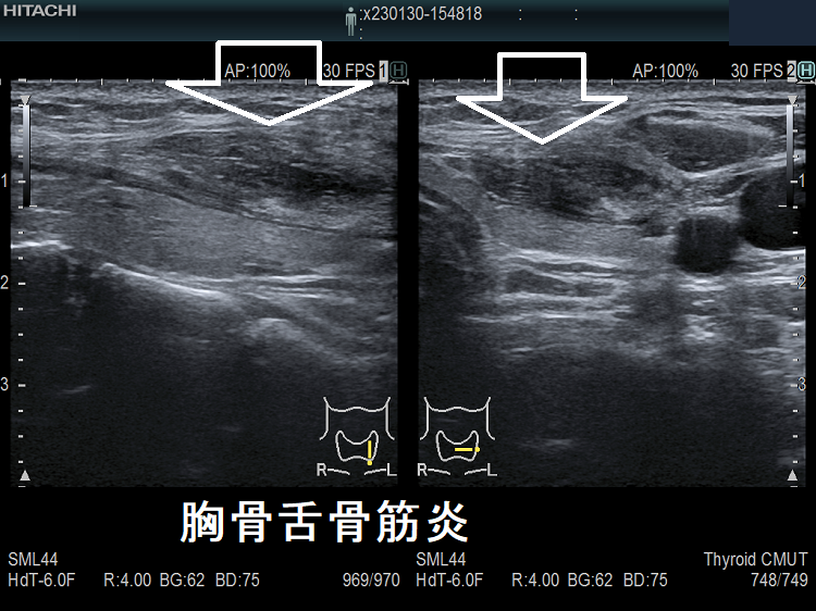 頸筋炎 胸骨舌骨筋炎 超音波(エコー)画像 胸骨舌骨筋炎3