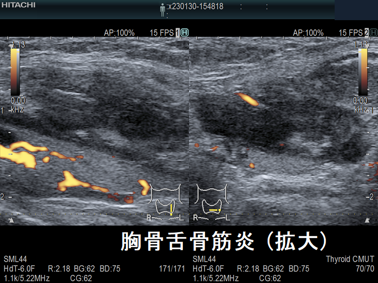 胸骨舌骨筋炎(拡大) 超音波(エコー)画像 ドプラーモード 胸骨舌骨筋炎(拡大) 超音波(エコー)画像 ドプラーモード