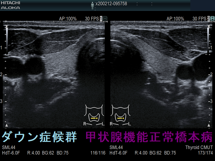 ダウン症候群 甲状腺機能正常橋本病 超音波(エコー)画像 ダウン症候群 甲状腺機能正常橋本病 超音波(エコー)画像