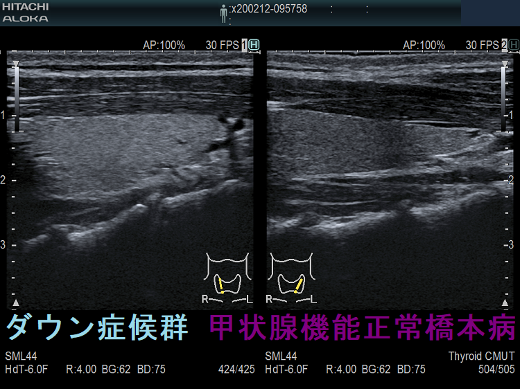 ダウン症候群の甲状腺機能正常橋本病 超音波(エコー)画像(縦断像) ダウン症候群の甲状腺機能正常橋本病 超音波(エコー)画像(縦断像)