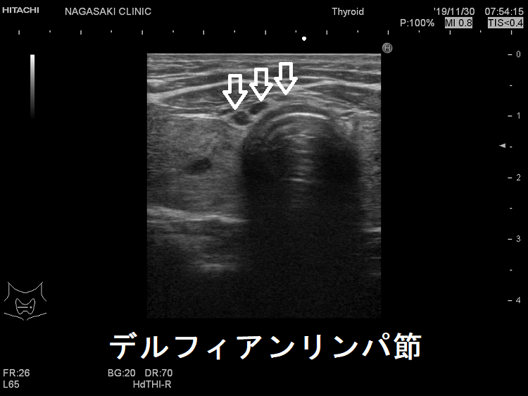 デルフィアンリンパ節 超音波エコー画像 デルフィアンリンパ節 超音波エコー画像