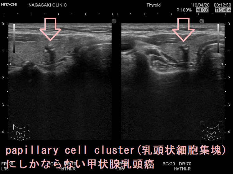 乳腺　画像と検査　乳腺 Imaging & Examination 3rd First-in-Human Evaluation of Site-Specifically Labeled 89Zr