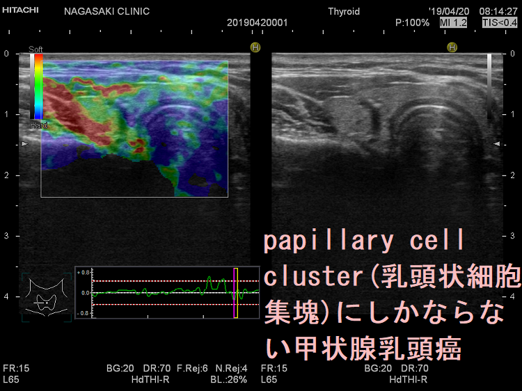 papillary cell cluster(乳頭状細胞集塊)にしかならない甲状腺乳頭癌 エラストグラフィー papillary cell cluster(乳頭状細胞集塊)にしかならない甲状腺乳頭癌 エラストグラフィー