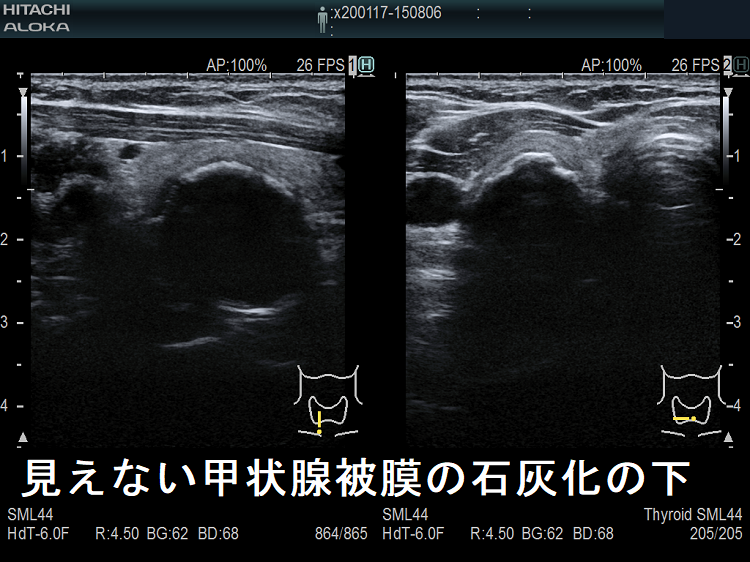 見えない甲状腺被膜の石灰化の下 超音波(エコー)画像 見えない甲状腺被膜の石灰化の下 超音波(エコー)画像