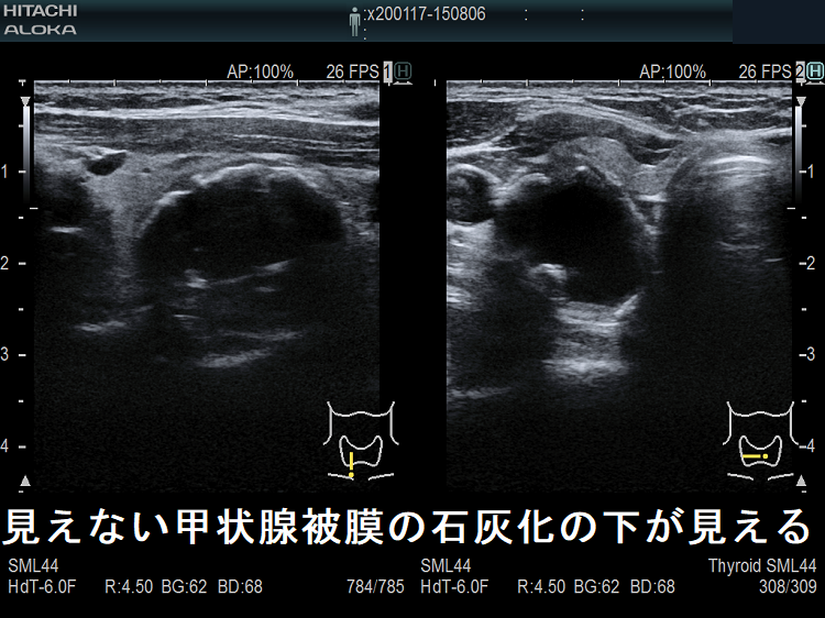 見えない甲状腺被膜の石灰化の下が見える 見えない甲状腺被膜の石灰化の下が見える